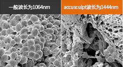 什么是AccuSculpt激光溶脂术？