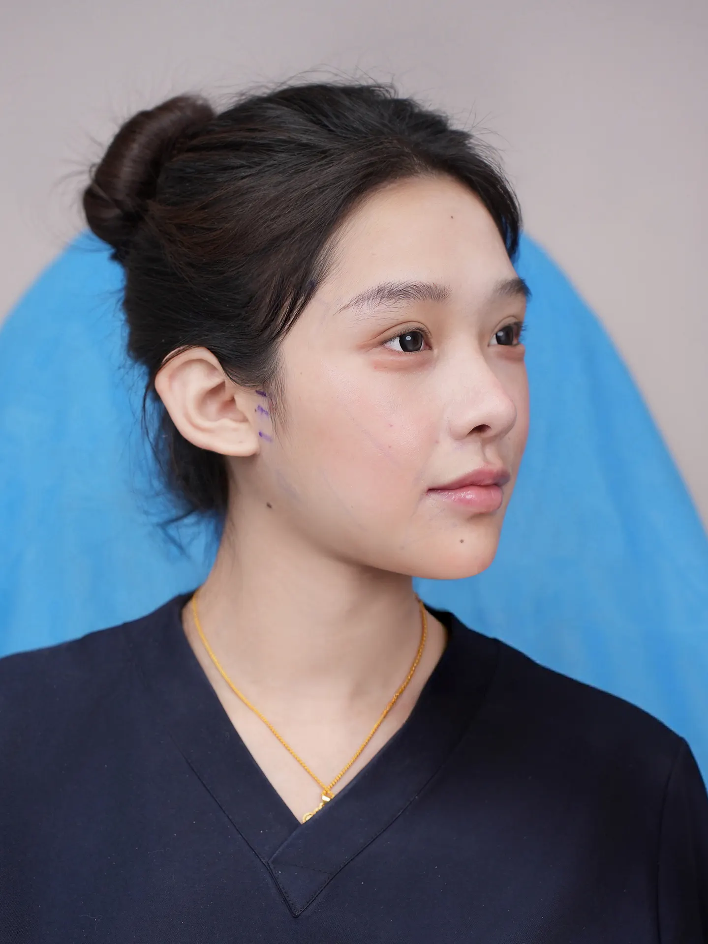 鼻部修复手术后记