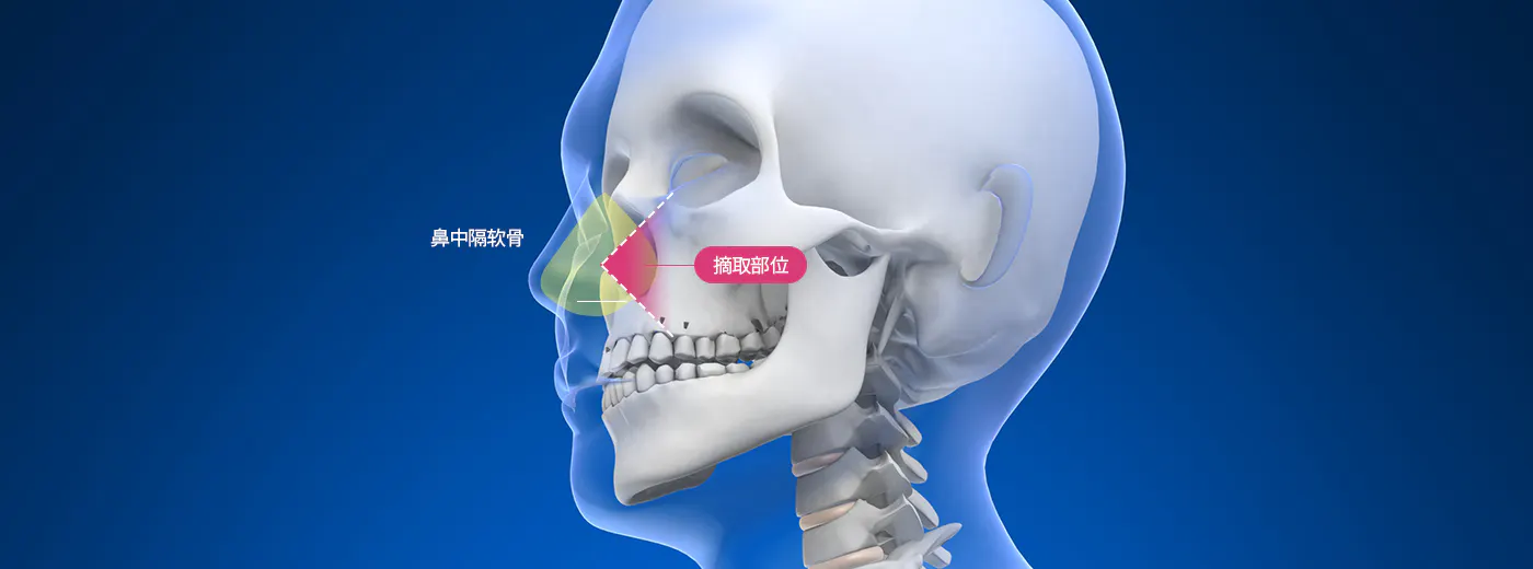 自体软骨
