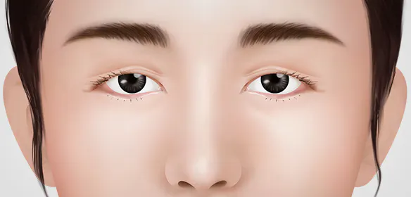 眼睑下垂的眼型矫正是什么？