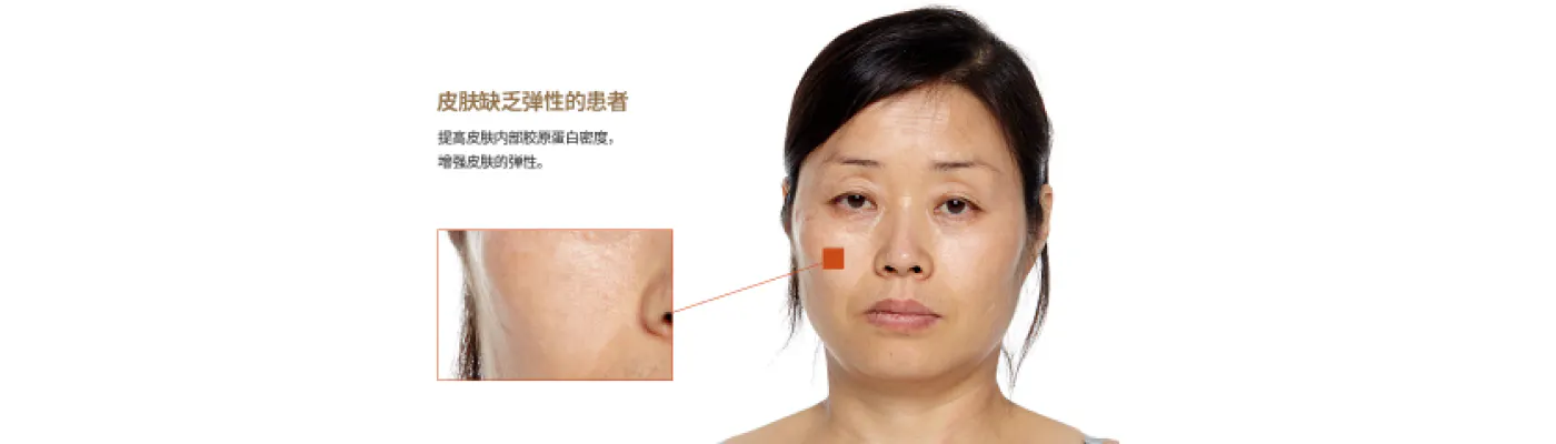 水光针对存在以下皮肤问题的患者非常有效