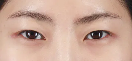 前后照片