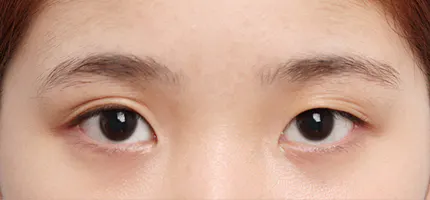 前后照片