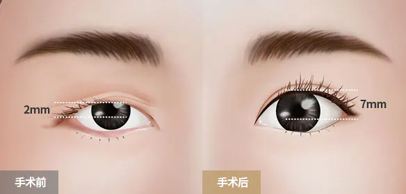 需要眼型矫正术，而不是双眼皮手术的原因！