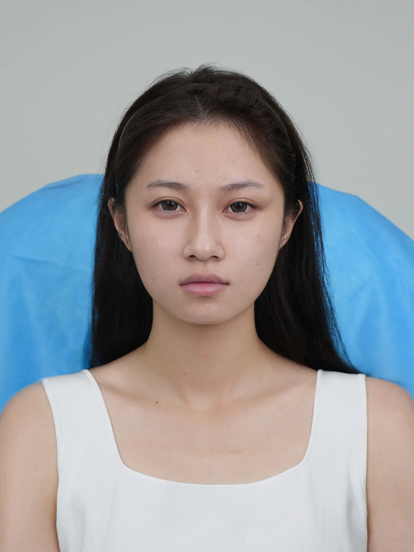 V形方颌缩小手术的手术方法