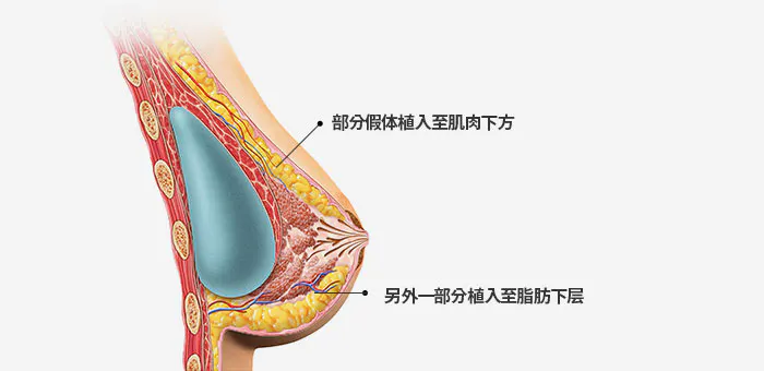 不同假体位置的手术方法