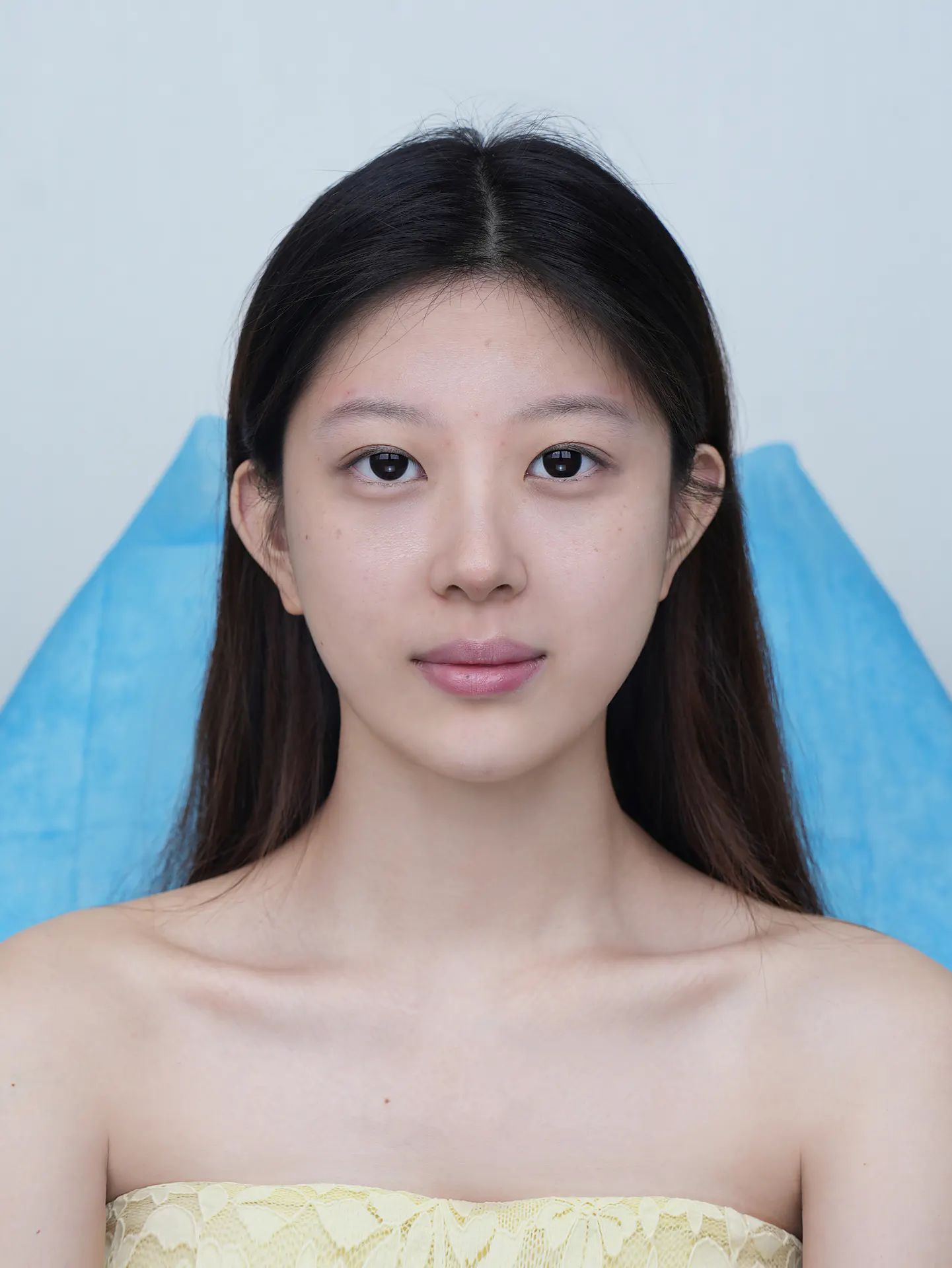 眼部整形前后照片