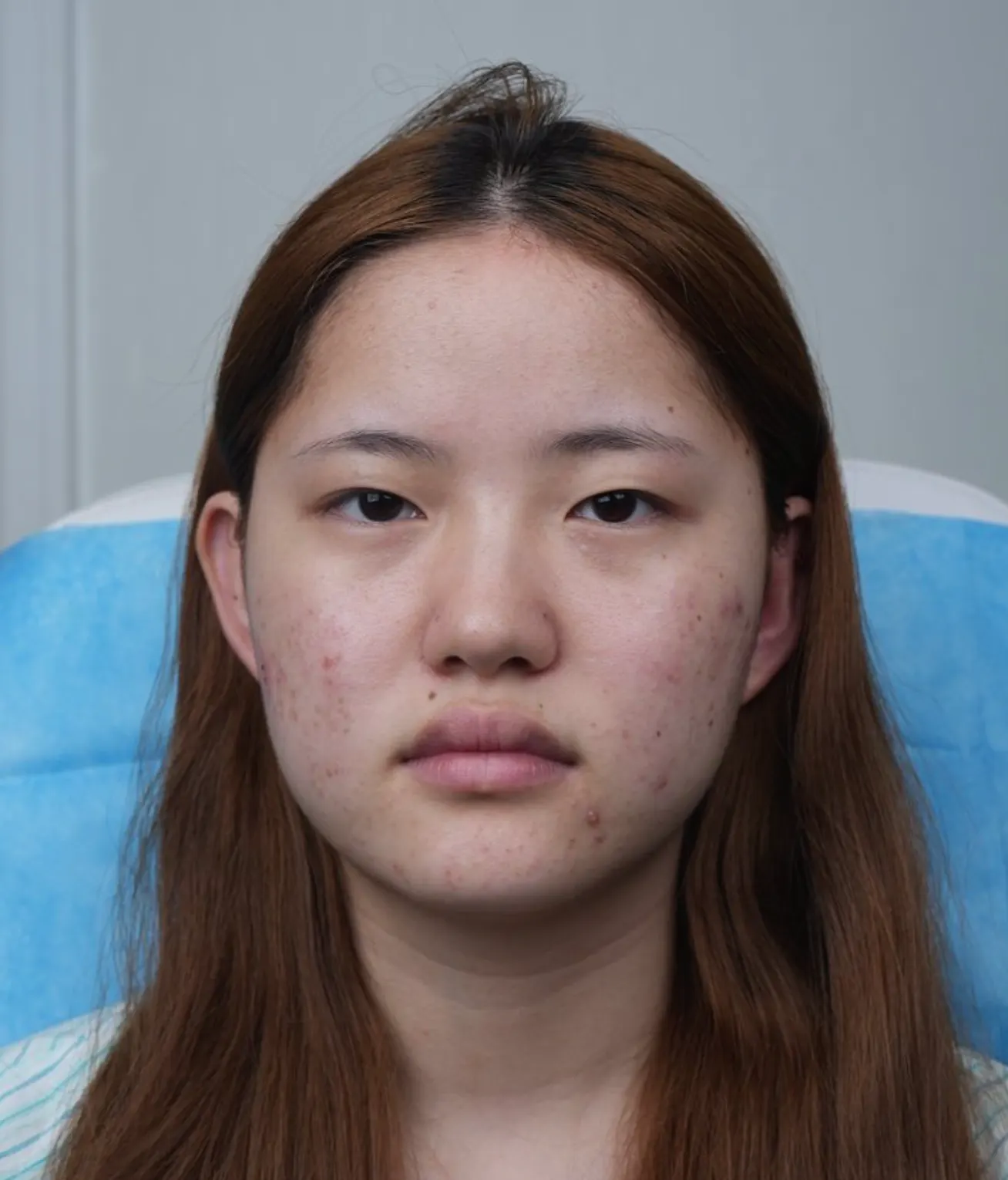 前后照片
