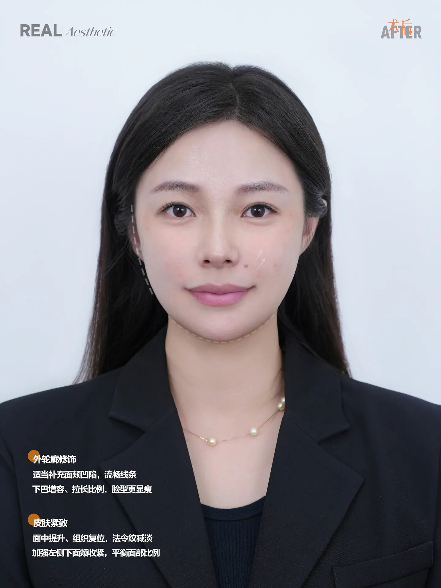 下巴不对称