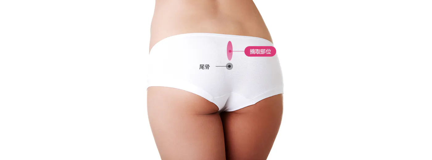 自体真皮