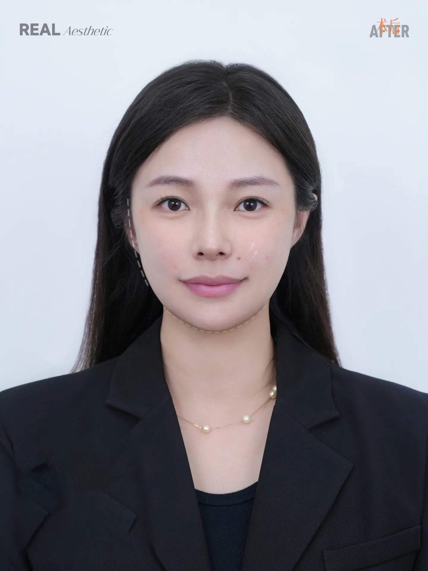 眼部手术后记