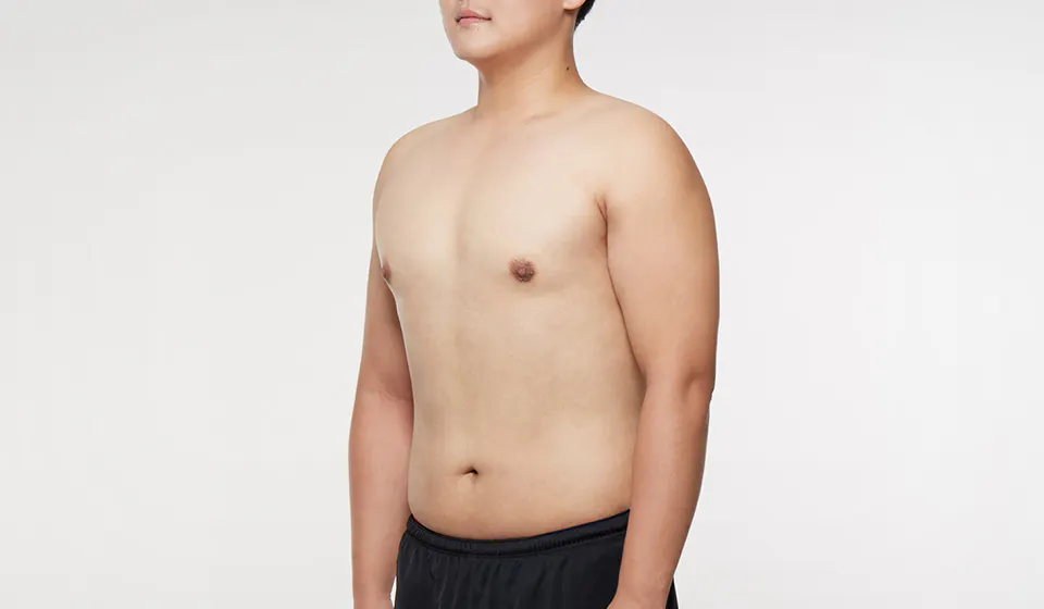 REAL男性乳房发育治疗